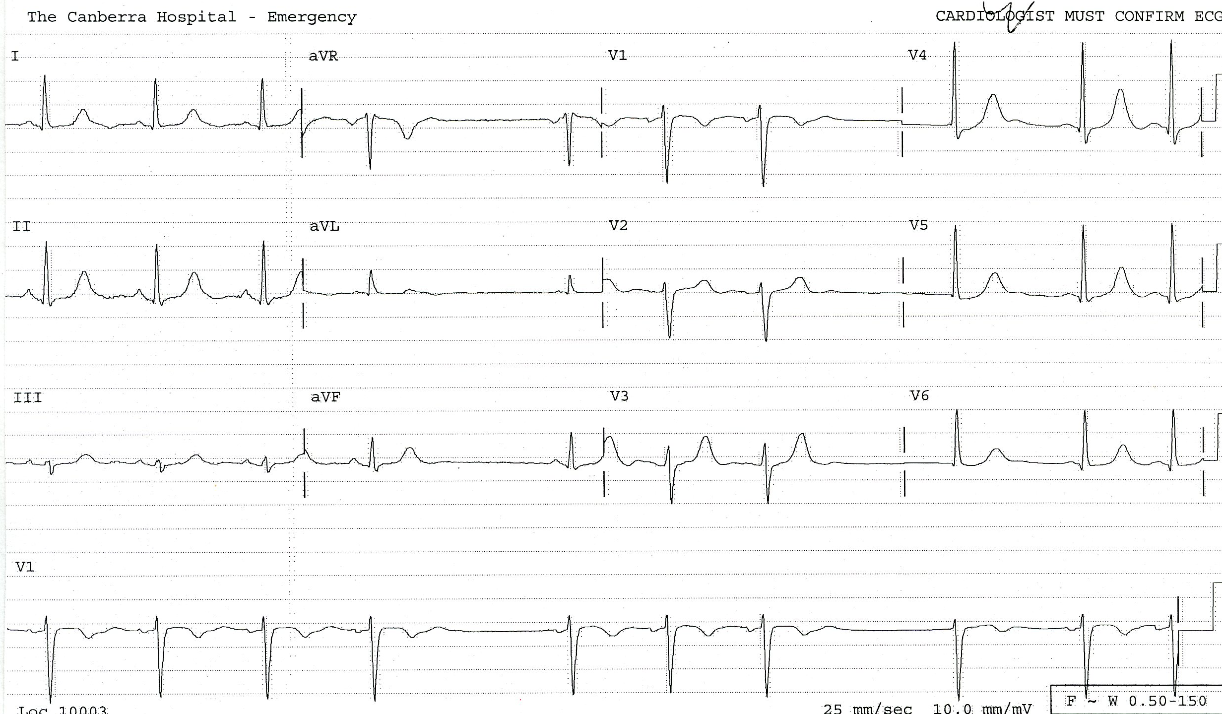 The negative U wave in lead 1 is more obvious than before. 