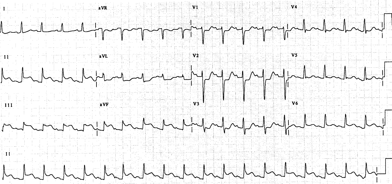 52 year old man resuscitated from VF at home.