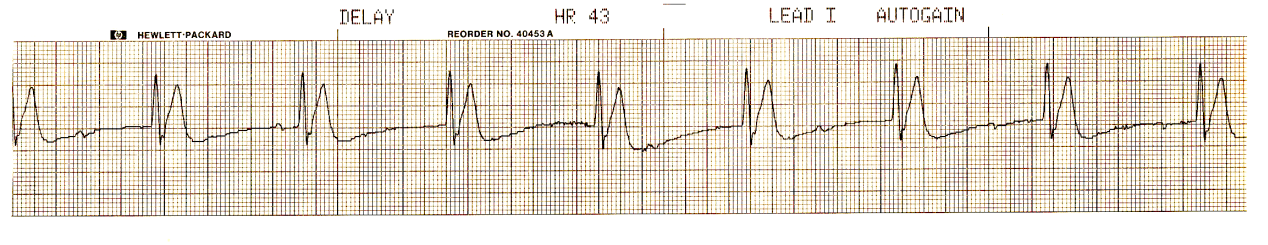 Lifepak monitor strip taken during unsuccessful resuscitation of a 71 year old man with acute inferior infarction and sudden onset of electromechanical dissociation (EMD). What could be the significance of the tall T waves recorded?