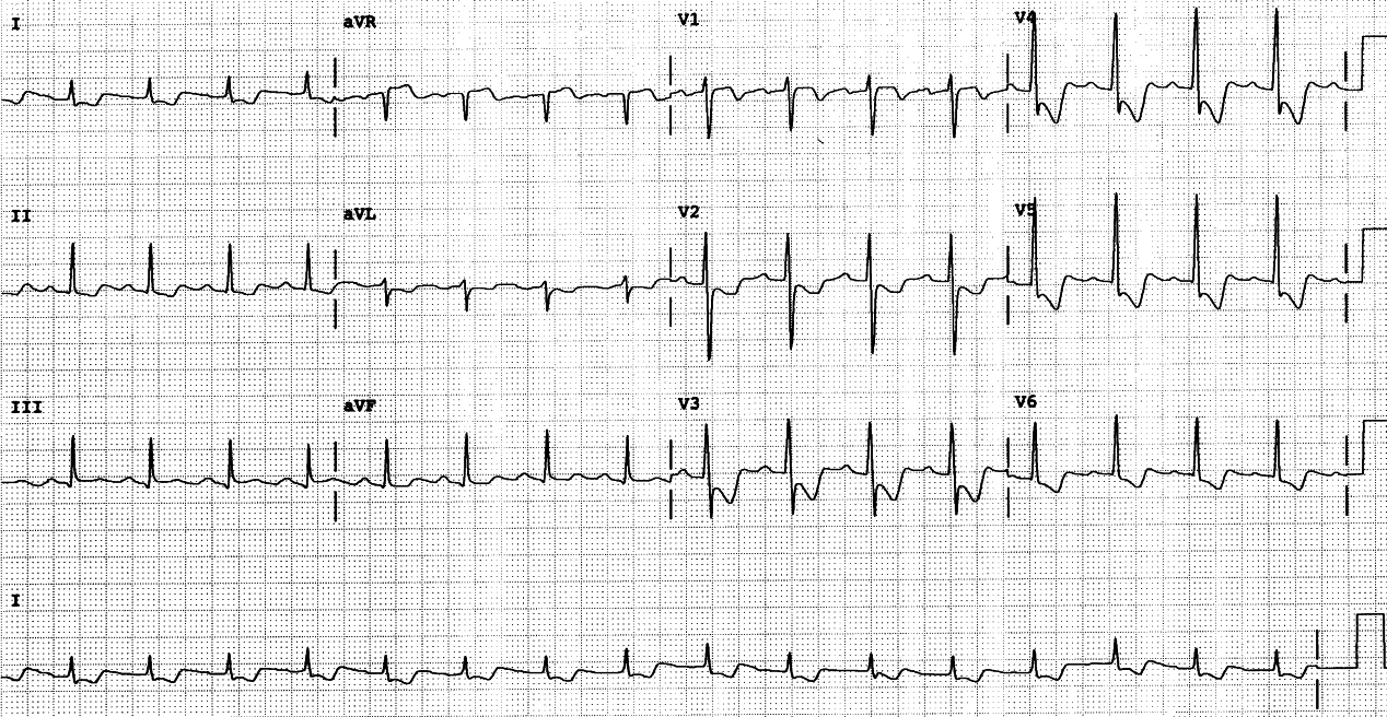 53 year old man with progressive angina. This ECG was taken in the Preadmission Clinic and he was sent to CCU.