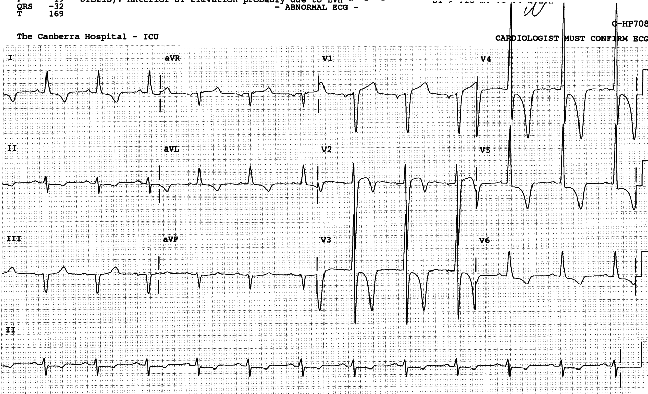 68 year old man with history of CABGs, treated by thrombolysis at another hospital. The AAA causing the original symptoms erupted into an aorto-caval fistula, repaired an hour before this ECG was recorded.  