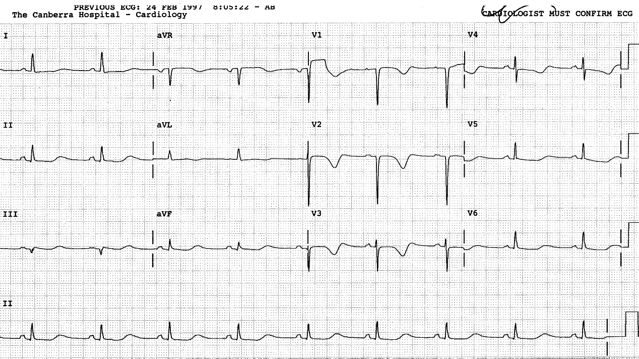 59 year old lady, cardioverted from AF after a week on digoxin and amiodarone therapy