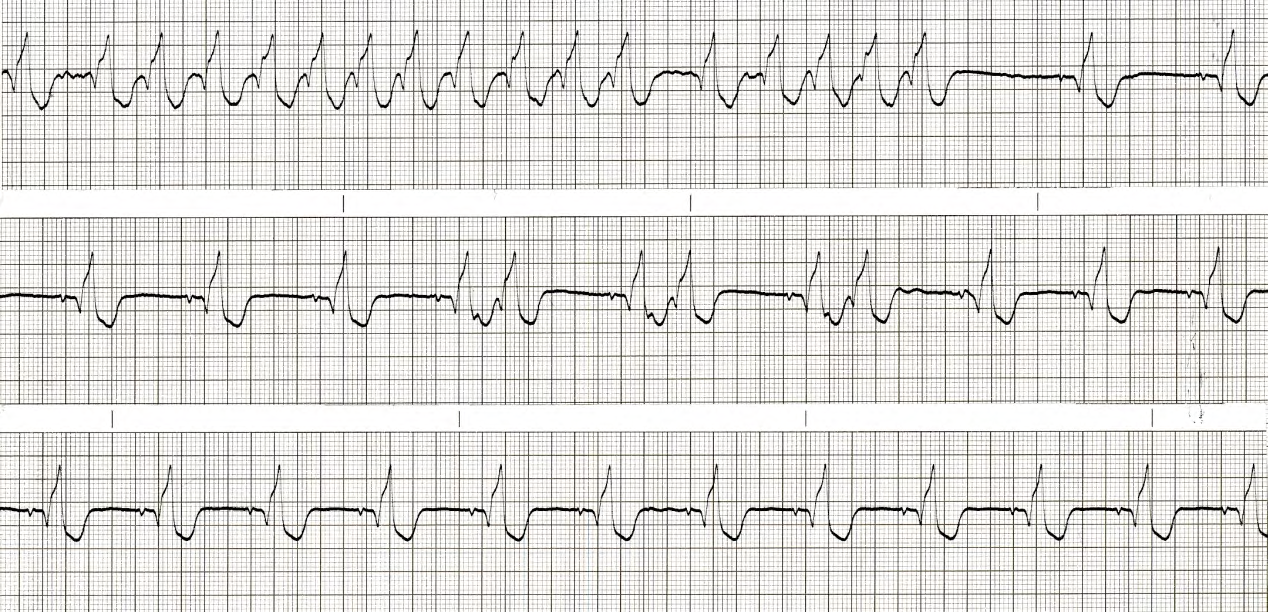 Plump RBBB complexes throughout. 