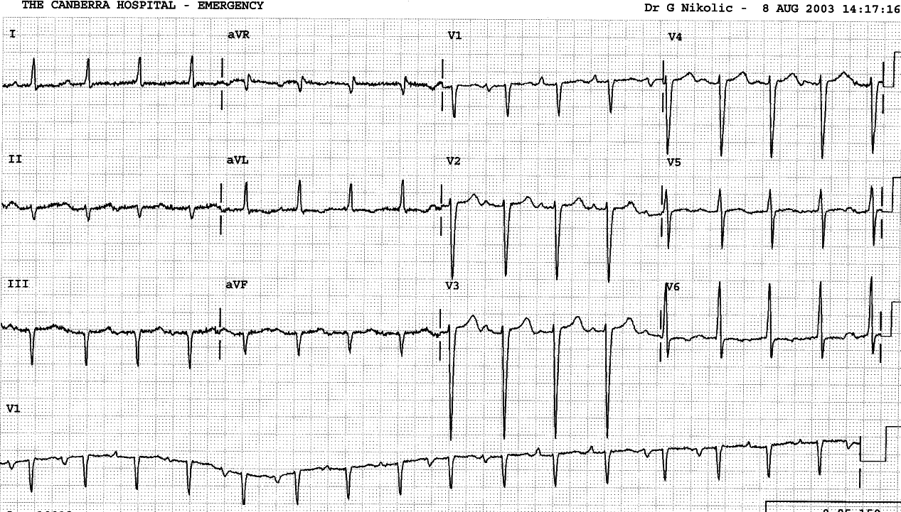 Both antegrade and retrograde P waves are present, with some intermediate (fusion) forms. 