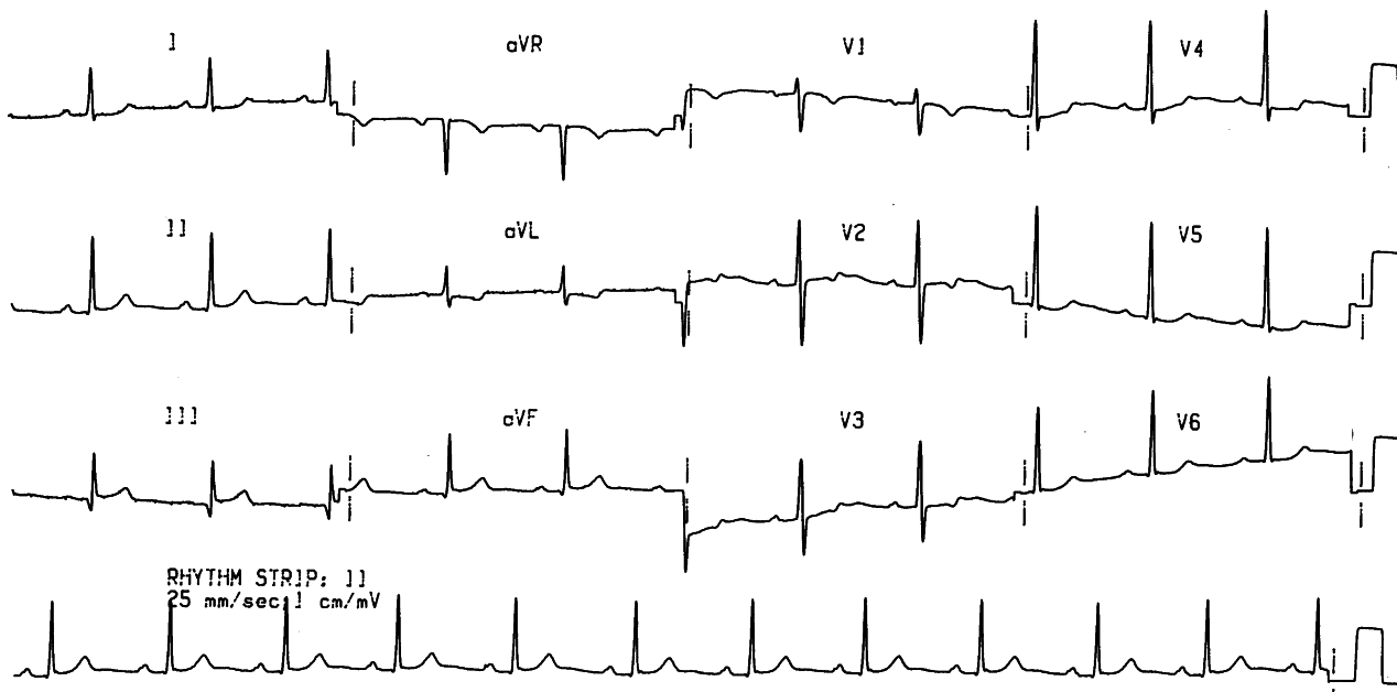 Five hours later, only relatively minor T wave changes remain in aVL and V2-4.