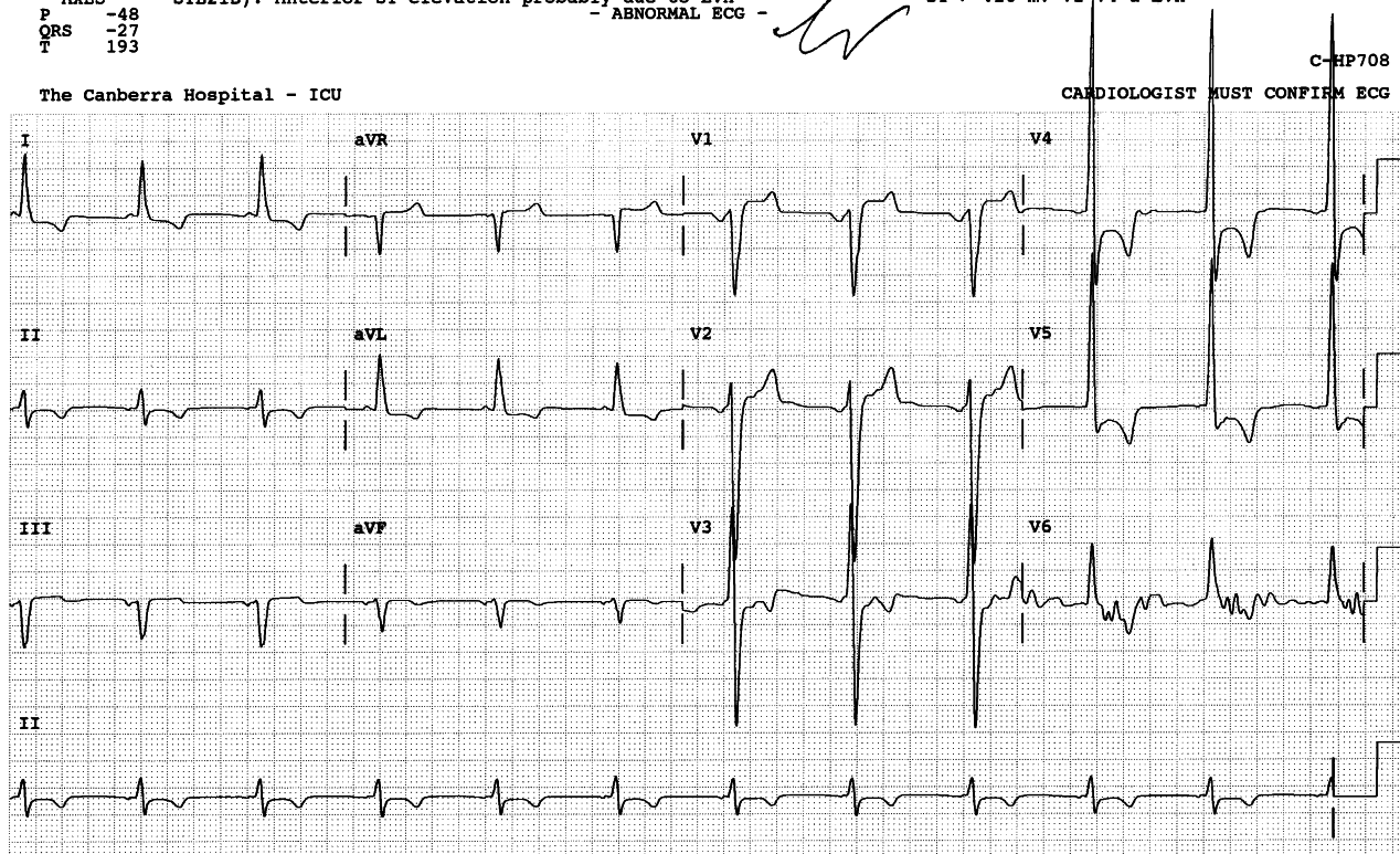 Preoperative ECG, taken upon transfer from a country hospital