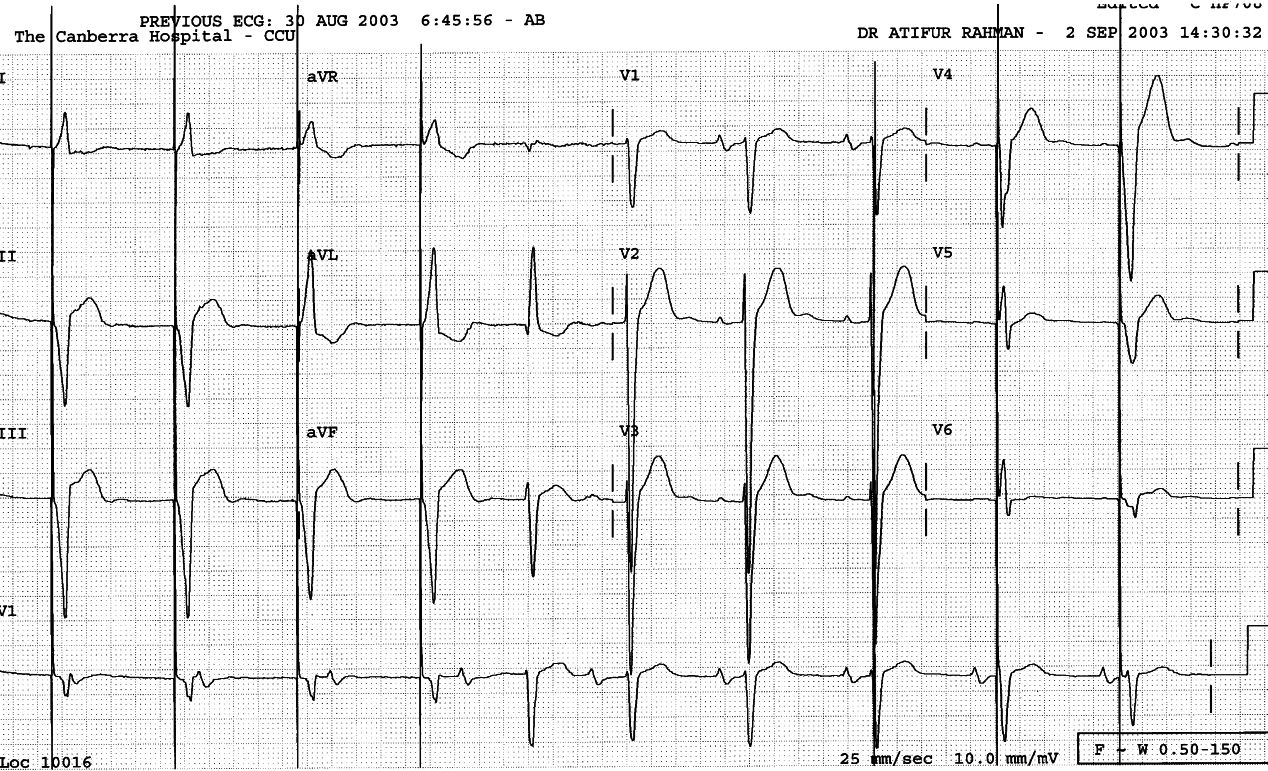 83 year old lady with sick sinus syndrome and permanent VVI
pacemaker.