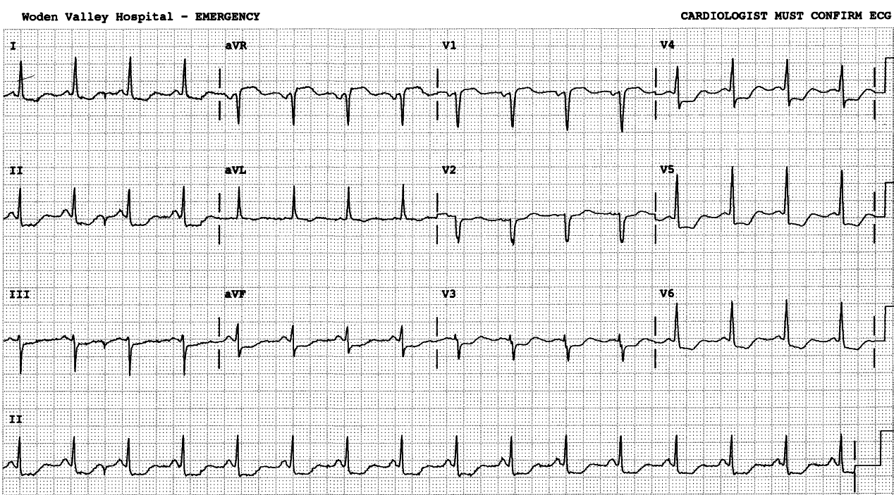 75 year old lady with chest pain in Casualty. The tracing is very similar to that in Fig 100.