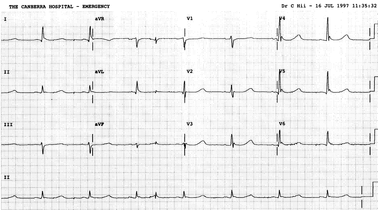 A previously fit farmer with weakness and obtundation over the past several days