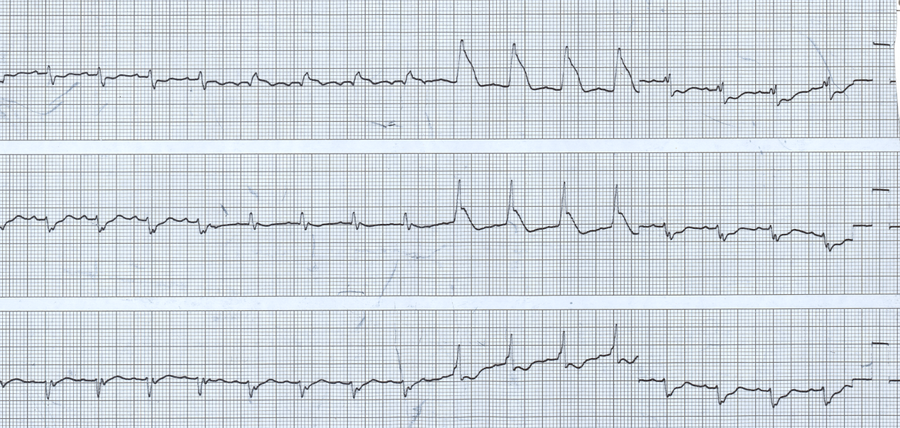 35 year old lady with a febrile illness and pleuritic chest pains. She died a day later