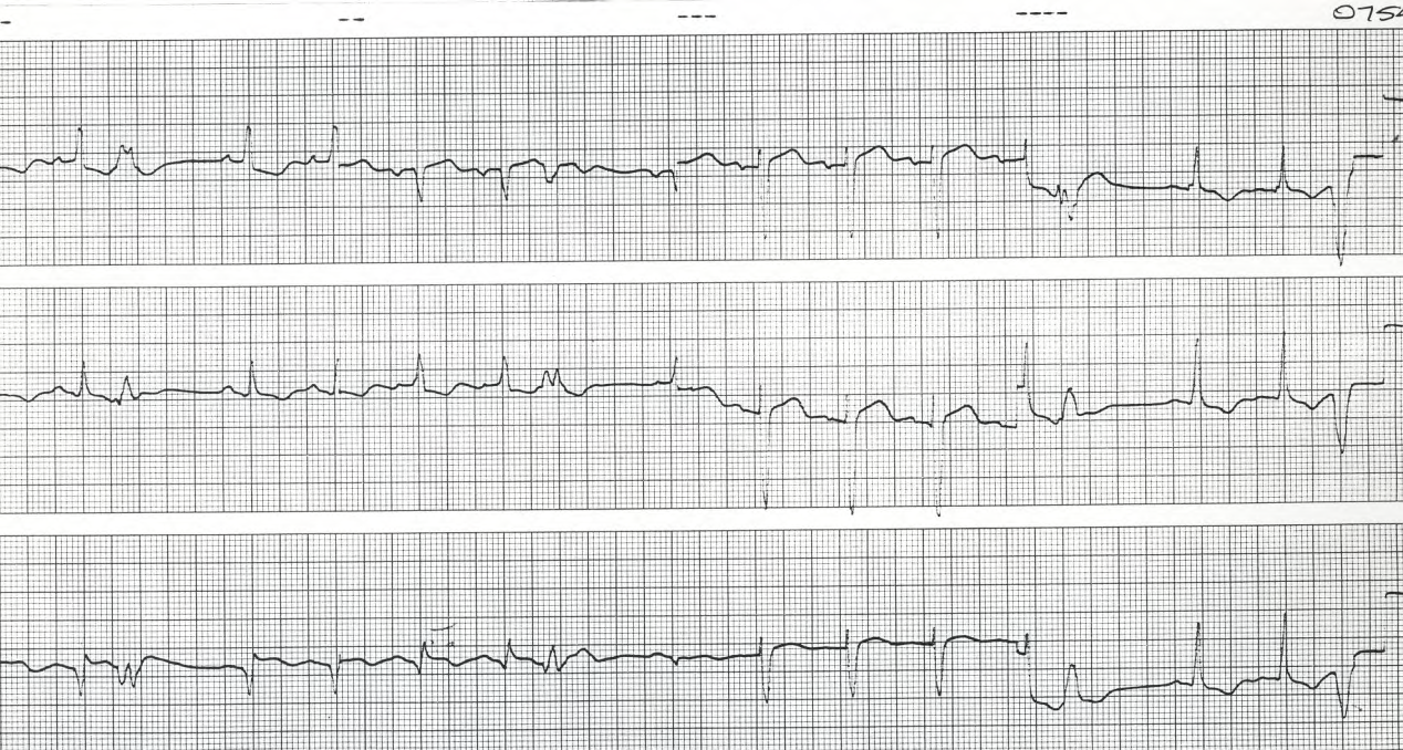 Sinus rhythm and VEBs. The latter preserve the pattern of inferior MI. 