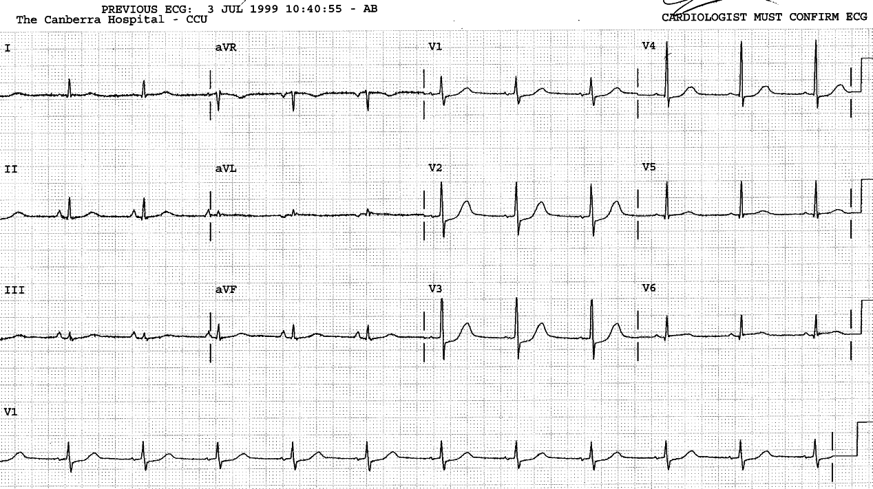 True posterior MI.