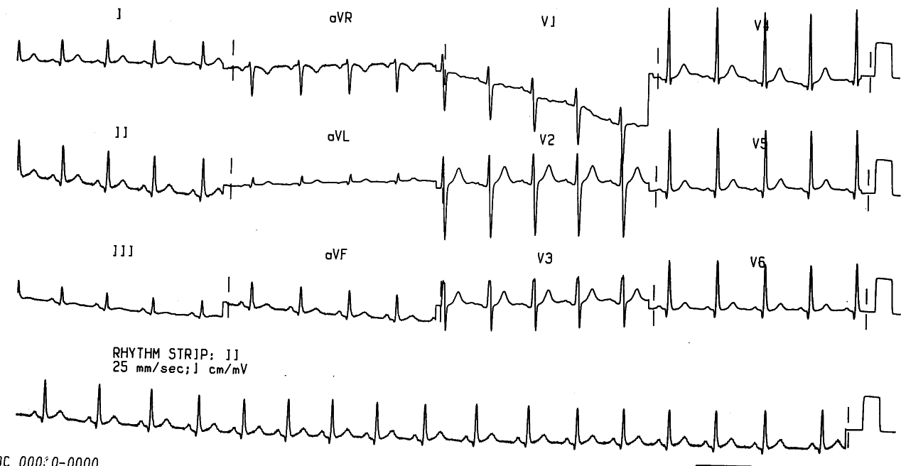 Sinus tachycardia 112/min (measured on grid paper) but no specific evidence of myocardial injury.