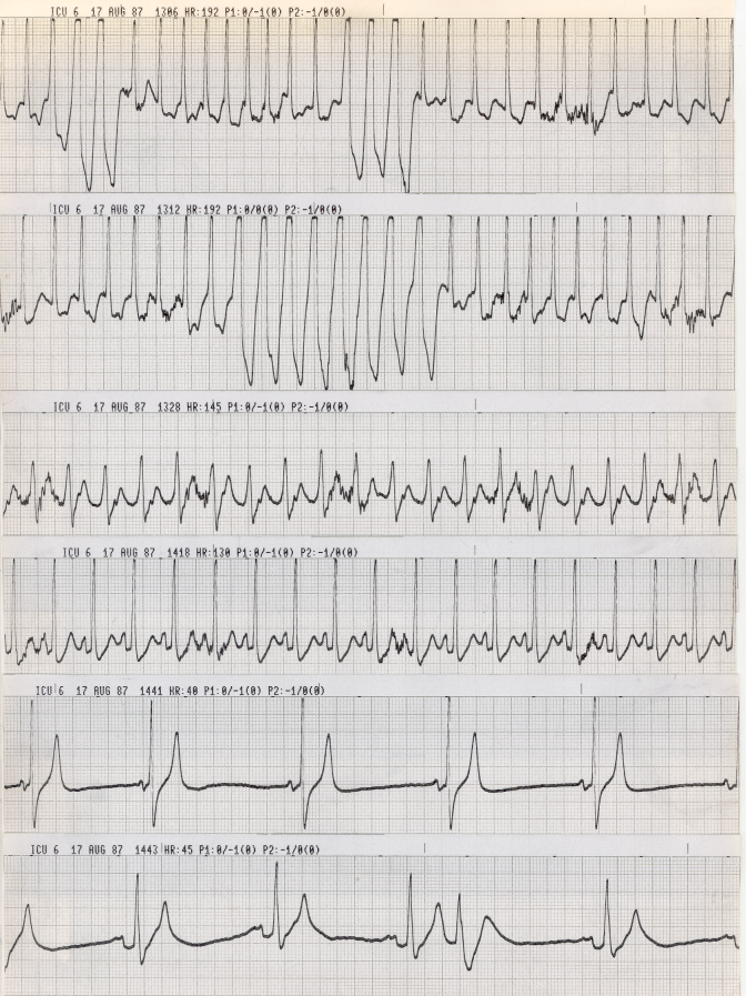 Agonal strips in a 60 year old alcoholic with hepato-renal syndrome