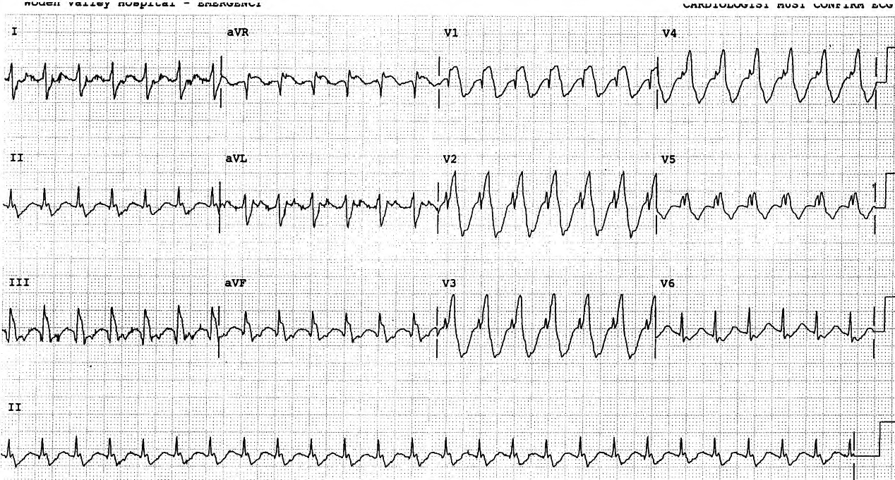 39 year old woman with history of tetralogy of Fallot repairs many years ago. There was no response to verapamil or sotalol. 