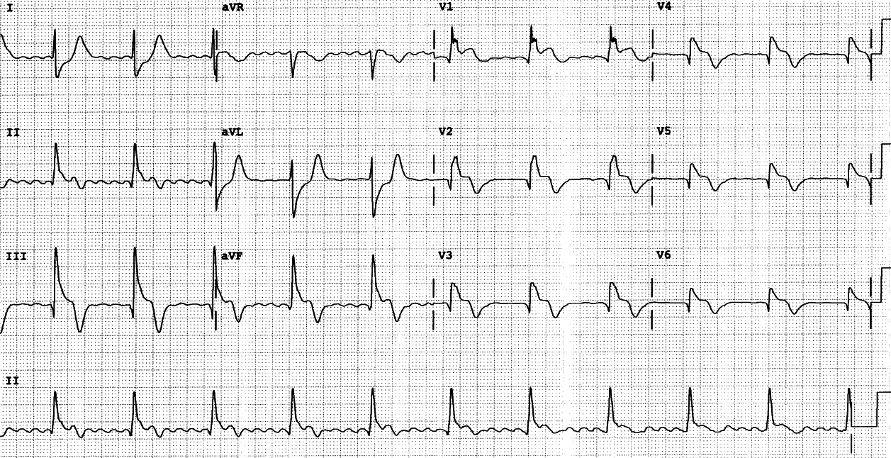 74 year old woman in cardiogenic shock. 