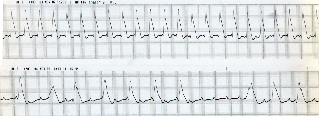 Dissociated junctional rhythm and two VEBs in the bottom strip.