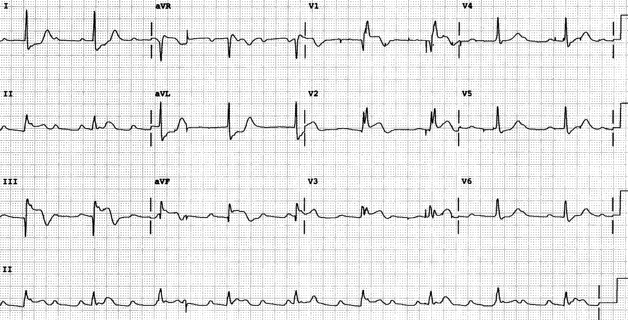 Sinus tachycardia reflects the patientâs distress. The precordial leads are left-sided. The RV infarction is obvious without any extra leads. 