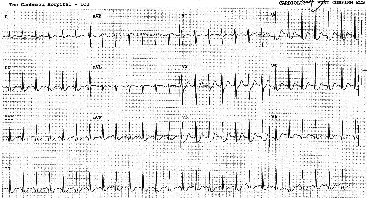 âStormingâ sinus tachycardia, day after recording in 25b. The T waves have normalised. Her heart was intrinsically normal