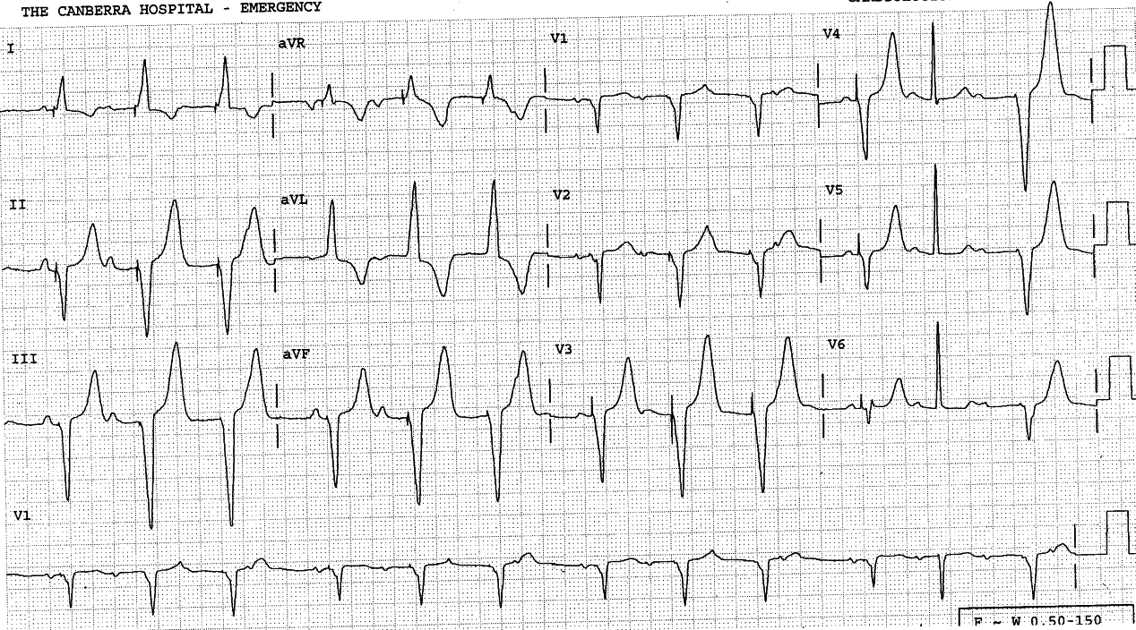 59 year old lady with permanent DDD pacemaker for AV nodal
disease. The settings include escape pacing rate 50/min, maximal rate
80/min, sensed AV interval 020â, pacing AV interval 0.24â and PVARP
0.36â; there is no rate hysteresis. The sensitivity was 1.0 mV. She
reported recurrent dizziness, pre-syncope, dyspnÅa and fatigue, but the
pacemaker function was normal when formally
tested.