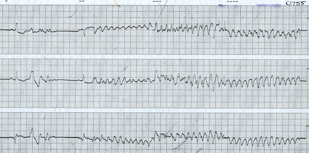 Mercifully short 12-lead ECG in a 73 year old man with old inferior infarction, in CCU. 