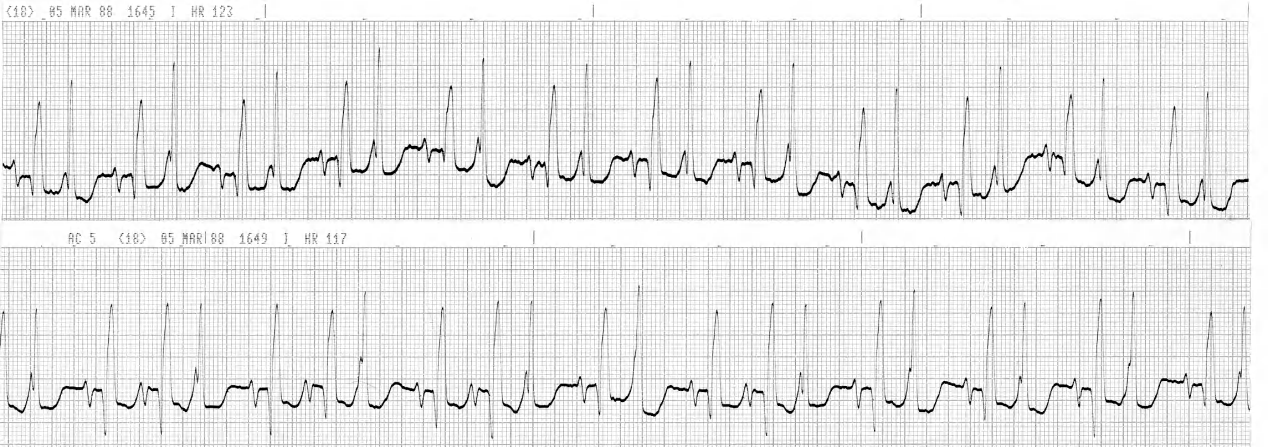 HypokalÃ¦mic 68 year old woman with âchest pain 5 days ago, shortness of breath nowâ. Lead V1 recording. 