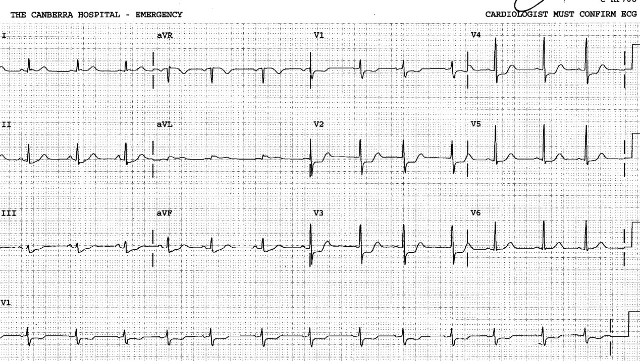 70 year old lady with chest pain.