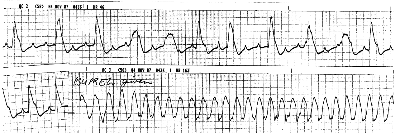 Isoprenaline effect in extreme sinus tachycardia.