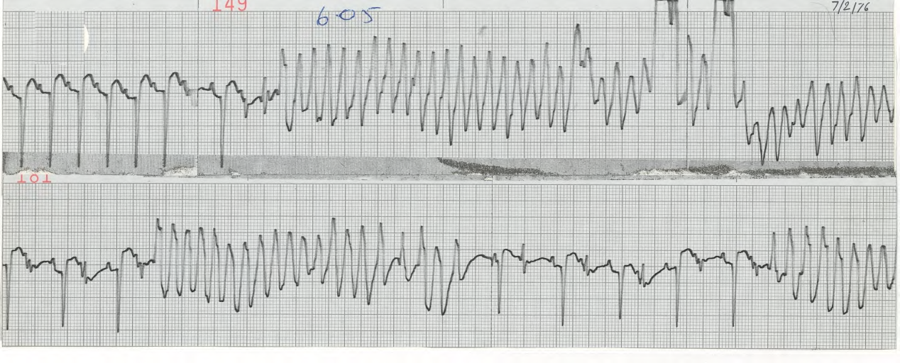 59 year old woman with acute anterior infarction, continued pain and left ventricular failure. 