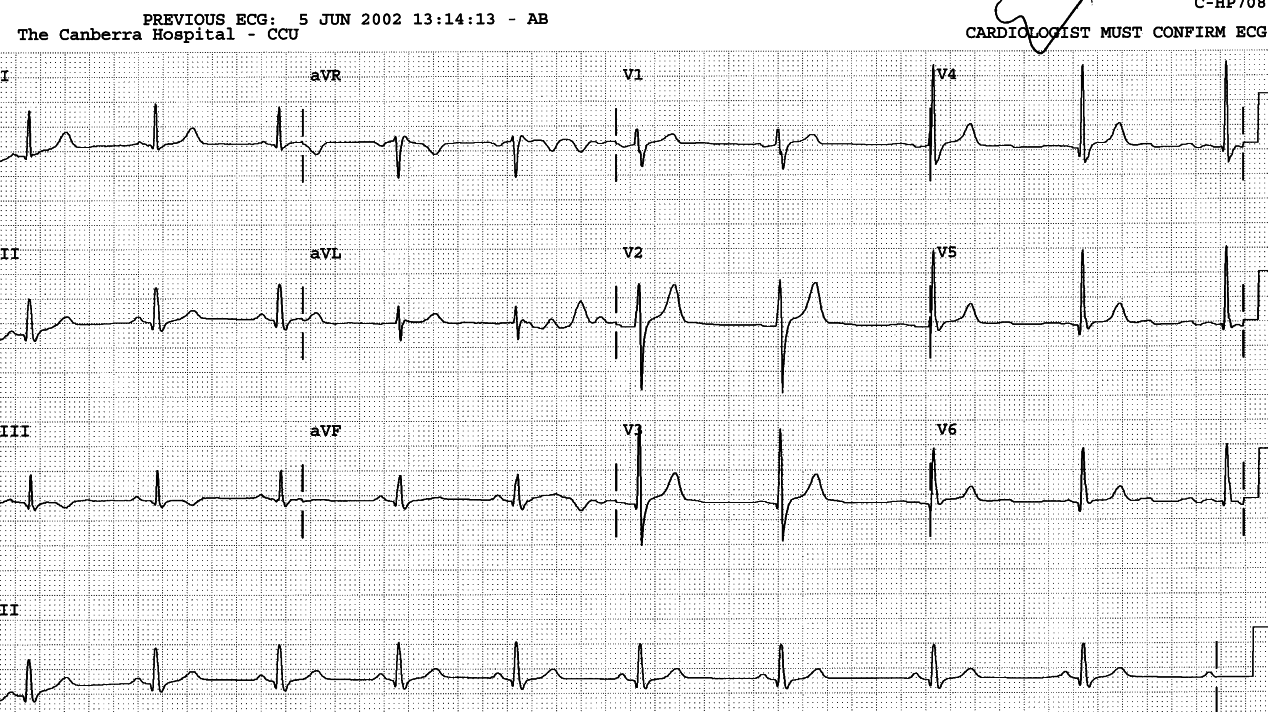 Normalised ECG post-PTCA.