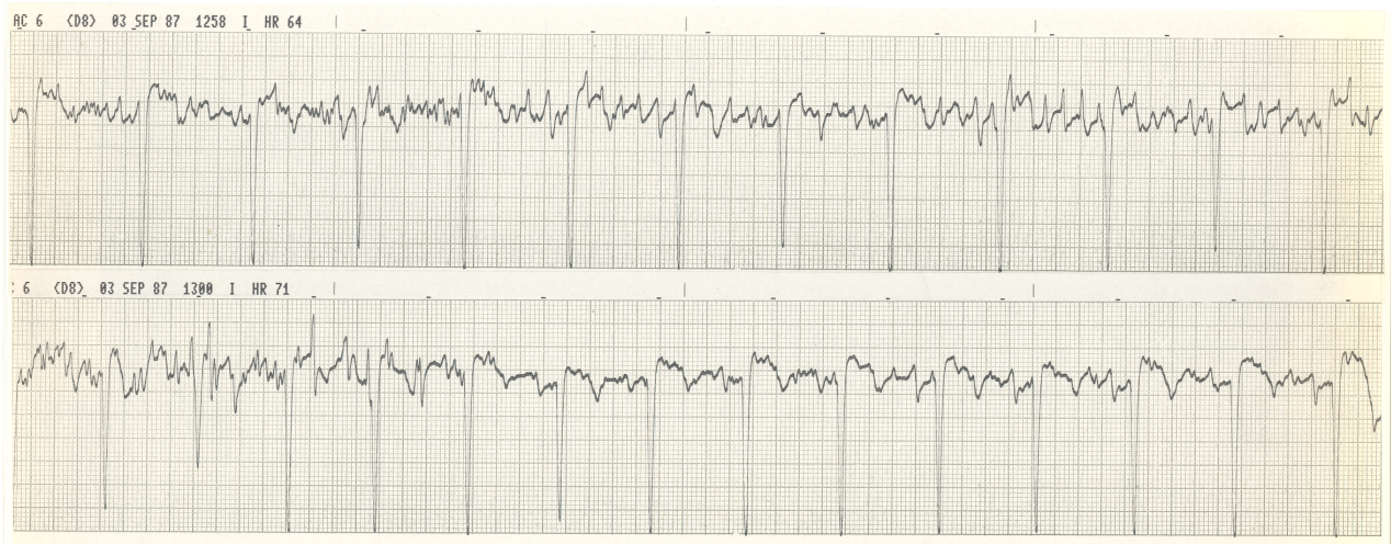 66 year old lady about to be discharged from CCU after stabilisation of angina. What should be done now?