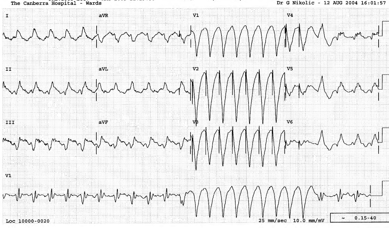 Broad complex tachycardia(s) in a 61 year old man with an implanted cardioverter-defibrillator (ICD). 