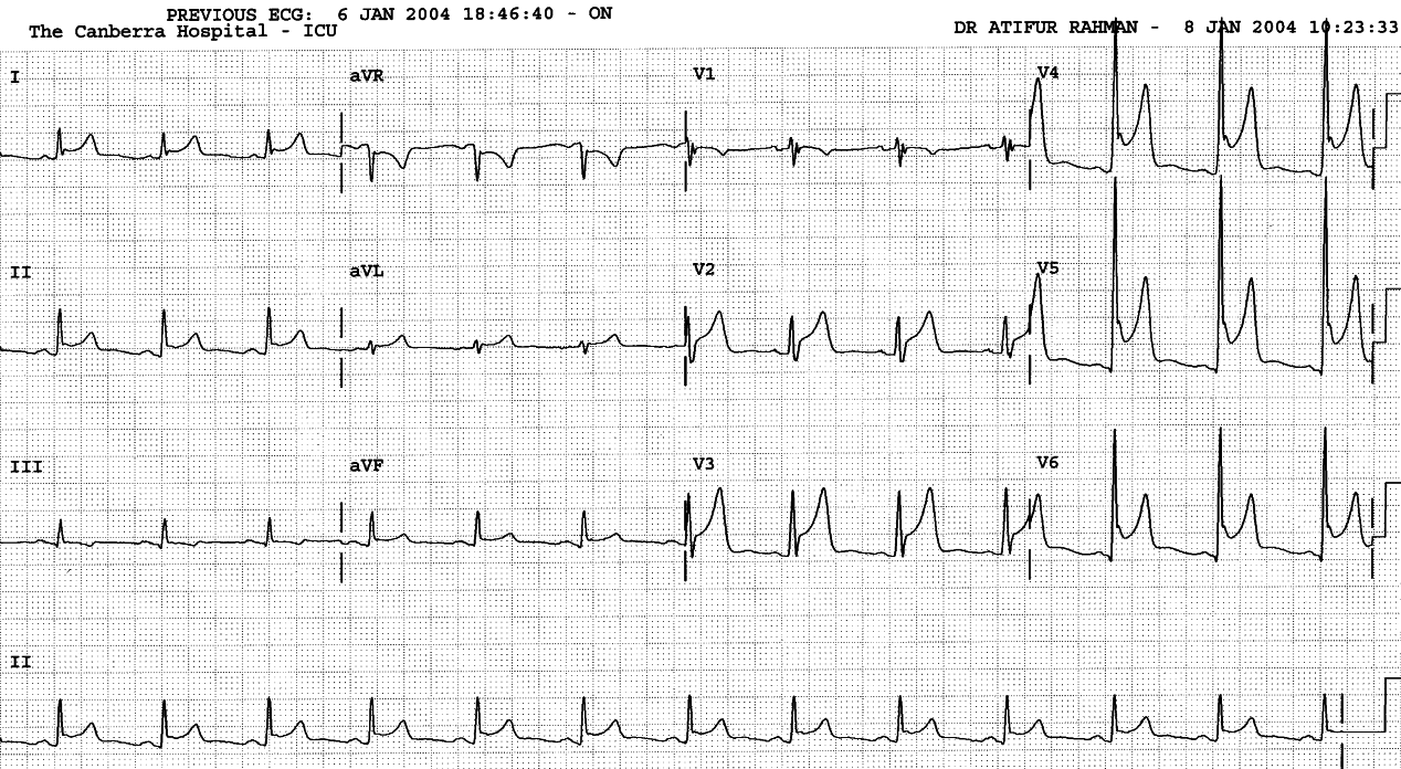 49 year old man following excision of endothelial fibroelastoma on one of the cusps of his aortic valve.