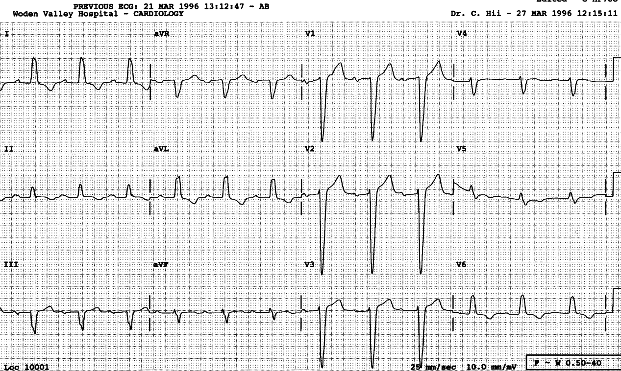 Sinus P waves can now be recognised as âbumpsâ hugging the tail of QRS complexes in the previous trace.