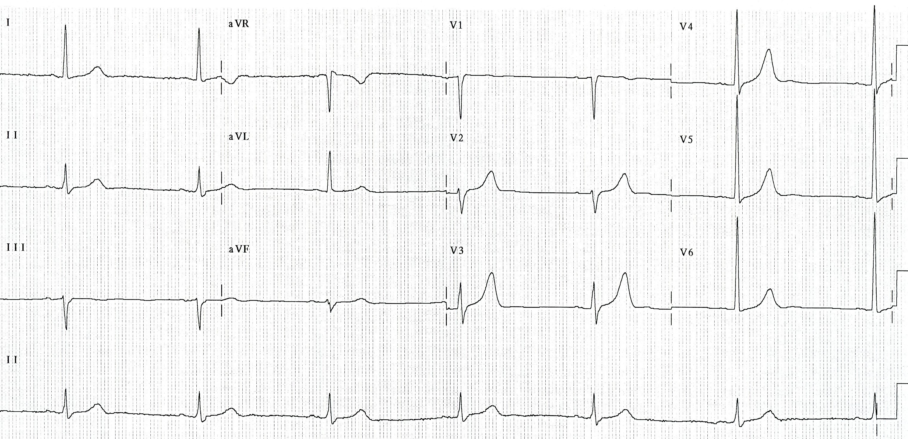 68 year old man with hyperlipidÃ¦mia, hypertension and positive stress test returning to CCU following PTCA to LAD and LCX arteries. Severe chest pain developed on arrival (Fig 111a). What is the likely cause?