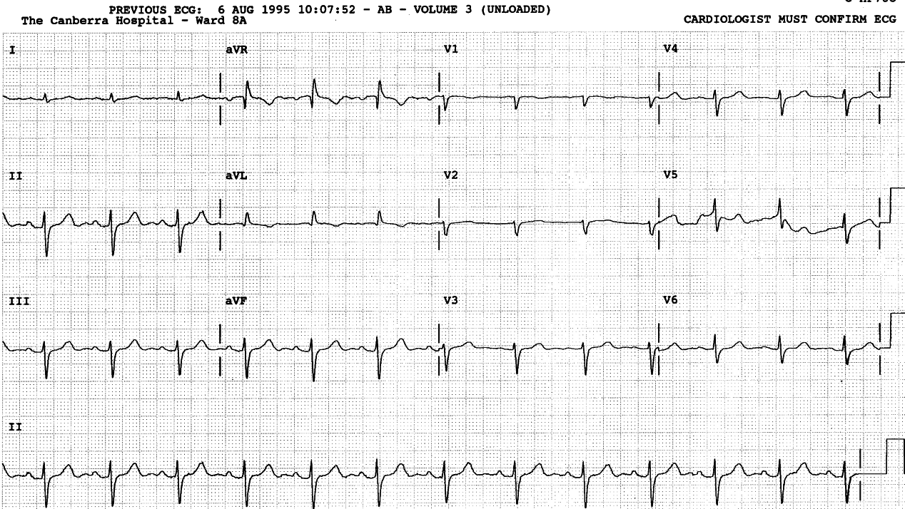 54 year old man with Î±-1 antitrypsin deficiency. His FEV1 is 0.88 vs predicted 3.55