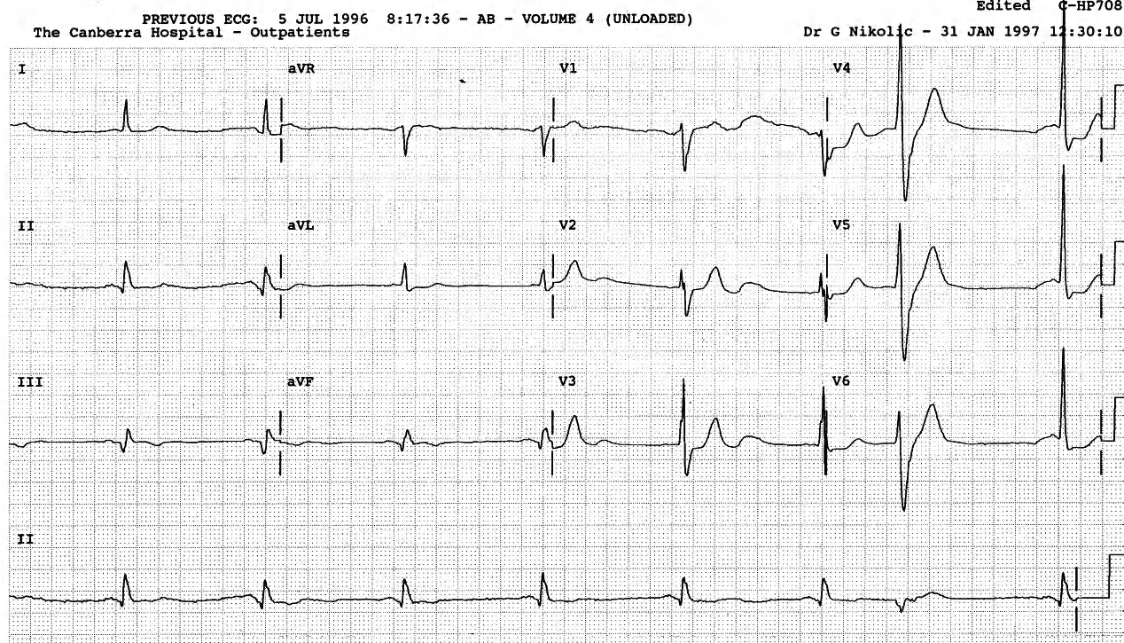 The large U wave in V1 is probably a movement artefact on top of an actual U wave. 