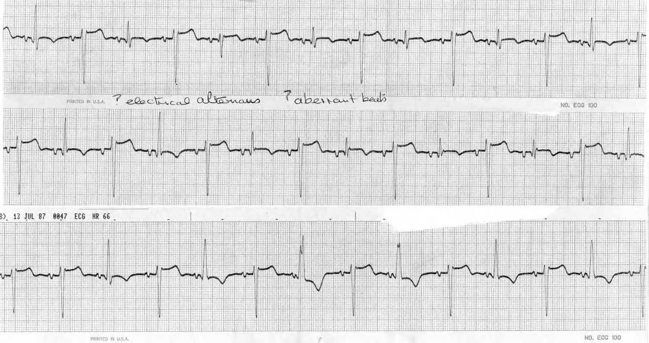 60 year old man with past history of sudden death and myocardial infarction. The arrhythmia below did not change the heart rate. Note the CCU nurseâs writing. 