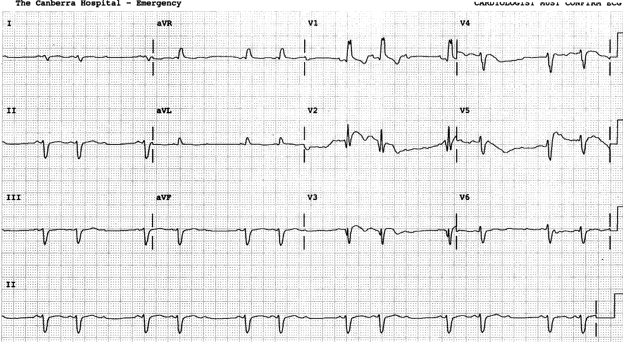 85 year old invalid living at home with his wife, admitted with respiratory infection and ileus. He is not taking any cardiac drugs, but recalls a âheart attackâ 15 years previously. 