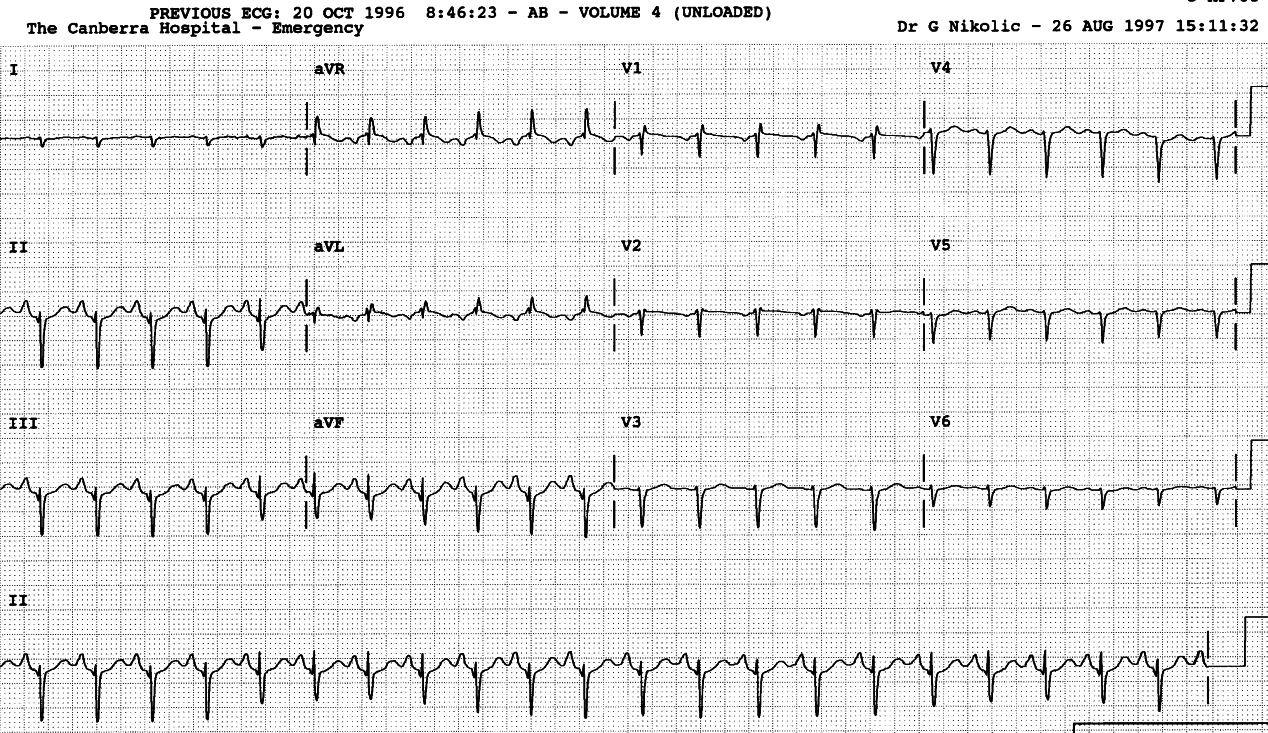 37 year old man with pulmonary hypertension and dilated right ventricle