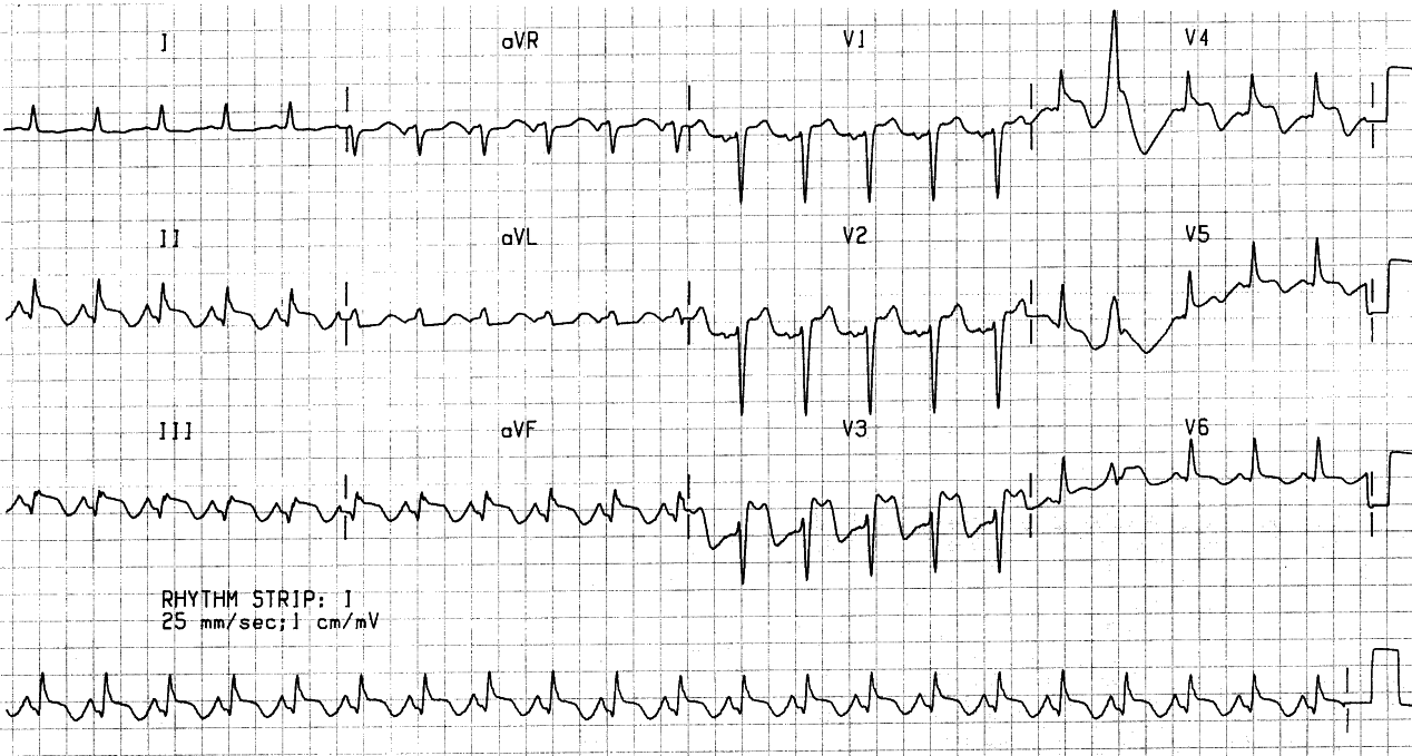 60 year old alcoholic woman unconscious from a large subdural hÃ¦matoma