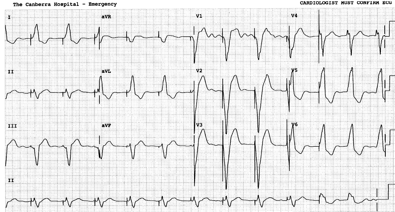 48 year old man with a permanent pacemaker and a conduction
defect obvious from this recording.