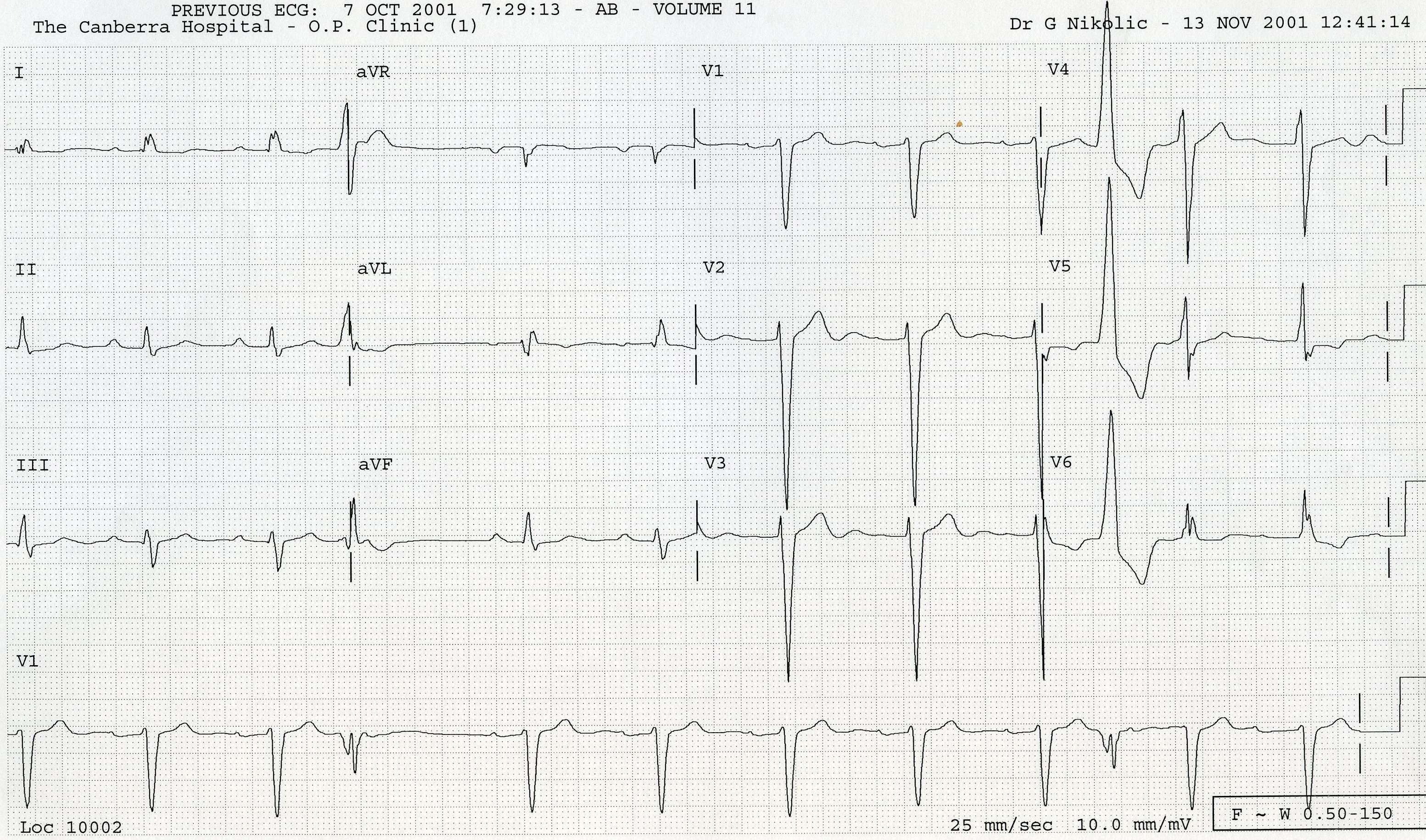 The first VEB has retrograde block; the second is interpolated like in Fig. 78 above. The longest cycle causes some right axis shift, but not as marked as short cycles in Fig 78. There is a 1o AVB throughout.