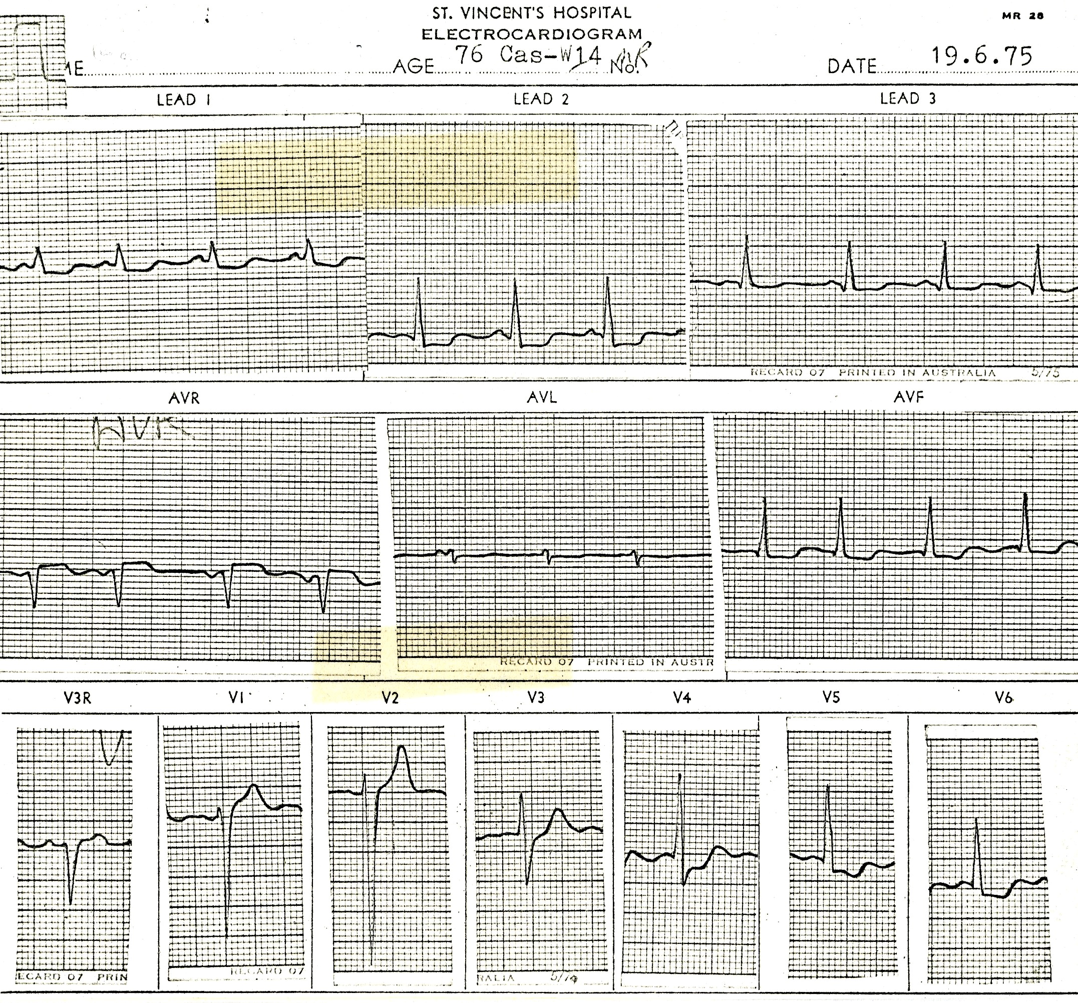 76 year old man in Casualty, hypotensive and in pain.