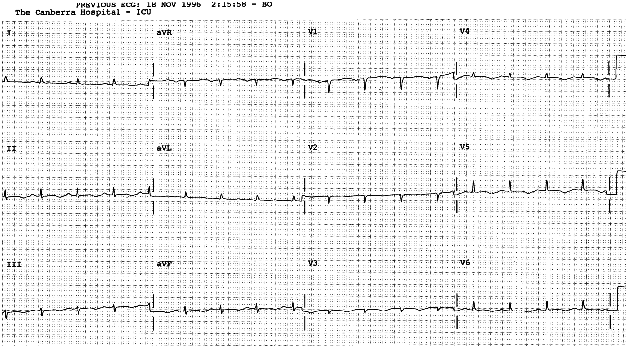 71 year old lady with cirrhosis, leg Ådema, ascites and pleural effusions