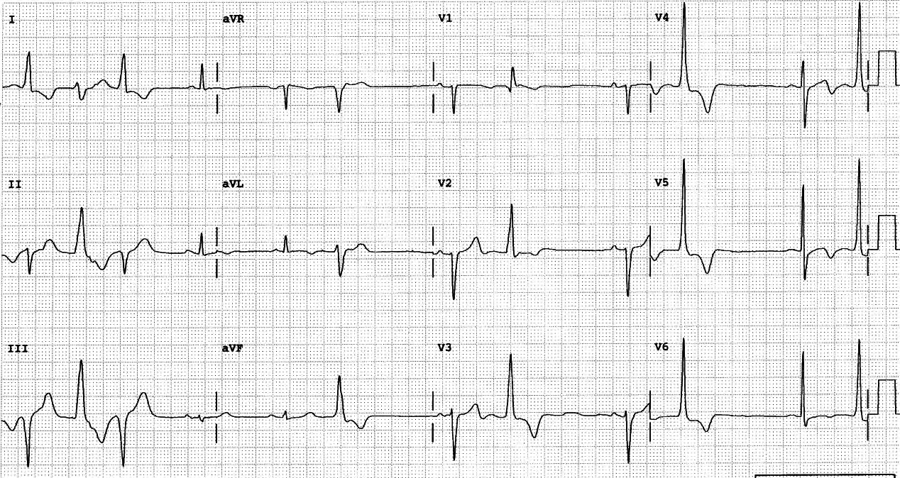 79 year old man with 90% LAD artery occlusion and impaired LV function, defibrillated in the angiography suite following RCA contrast injection. A Cardiologist reported this ECG as follows: âSinus rhythm. VEBs. Left anterior hemiblock. Non-specific anterolateral T wave abnormalities.â His report could be improved. 