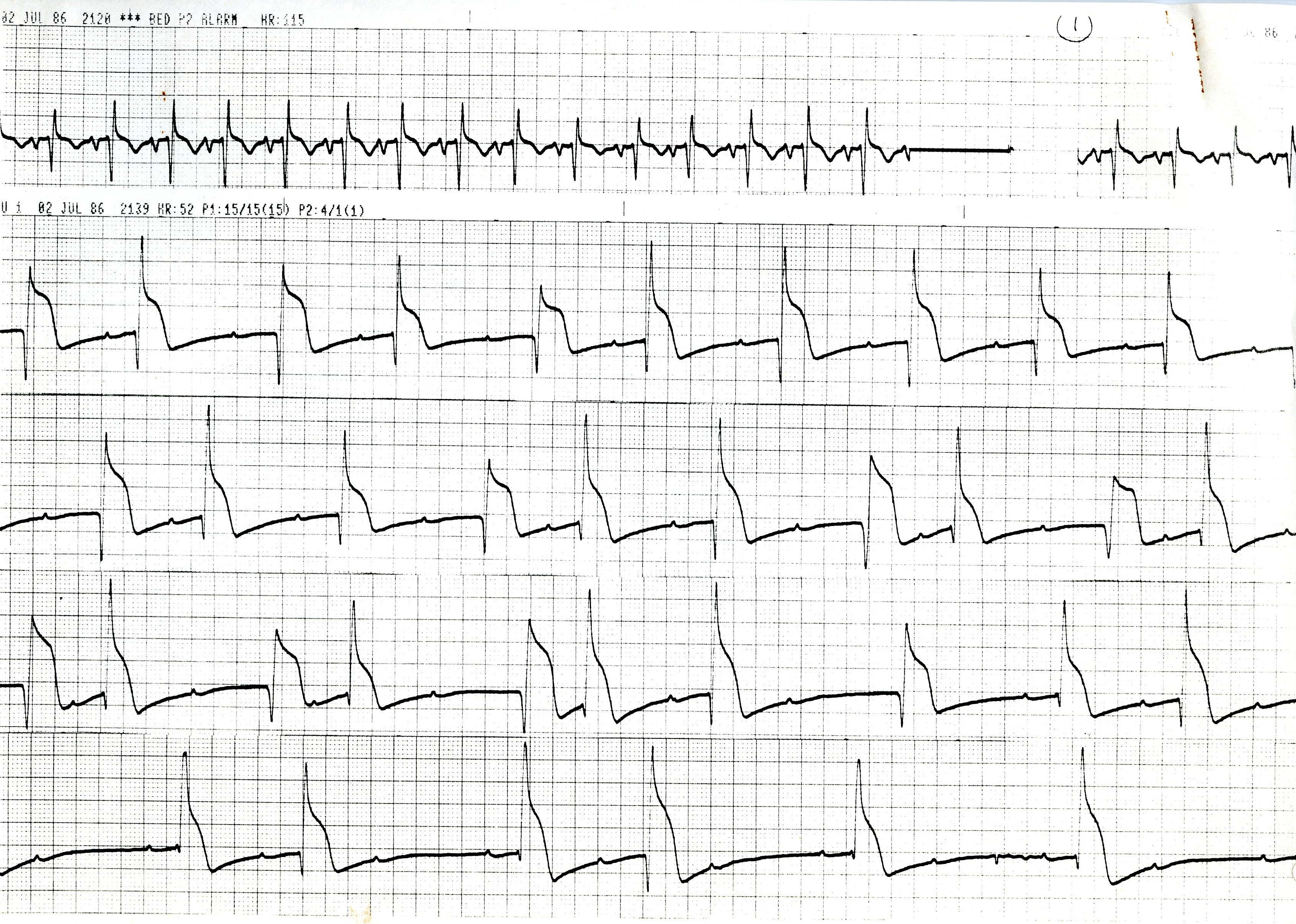 58 year old man with ARDS from septic shock, with metabolic acidosis and hypotension (BP 70 mmHg systolic). The MCL1 monitor lead changes appeared suddenly and without any observable provocation.