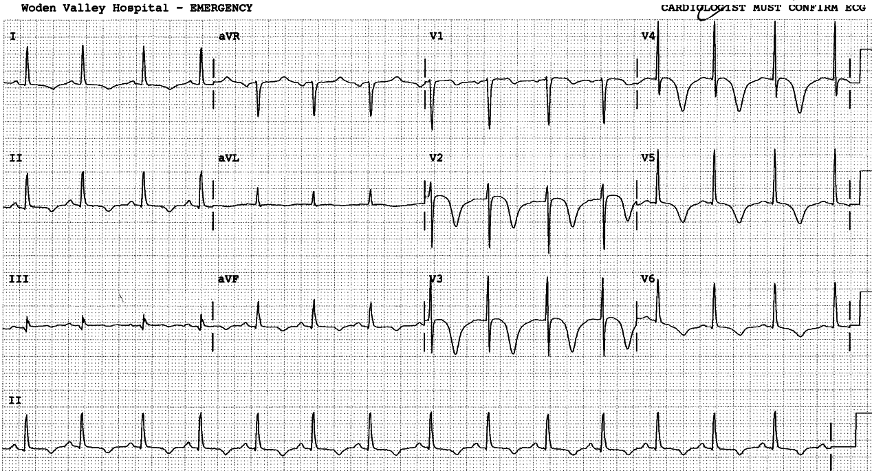 53 year old lady with pleuritic chest pains. She had a long history of hypertension, but the ECGs were always normal.