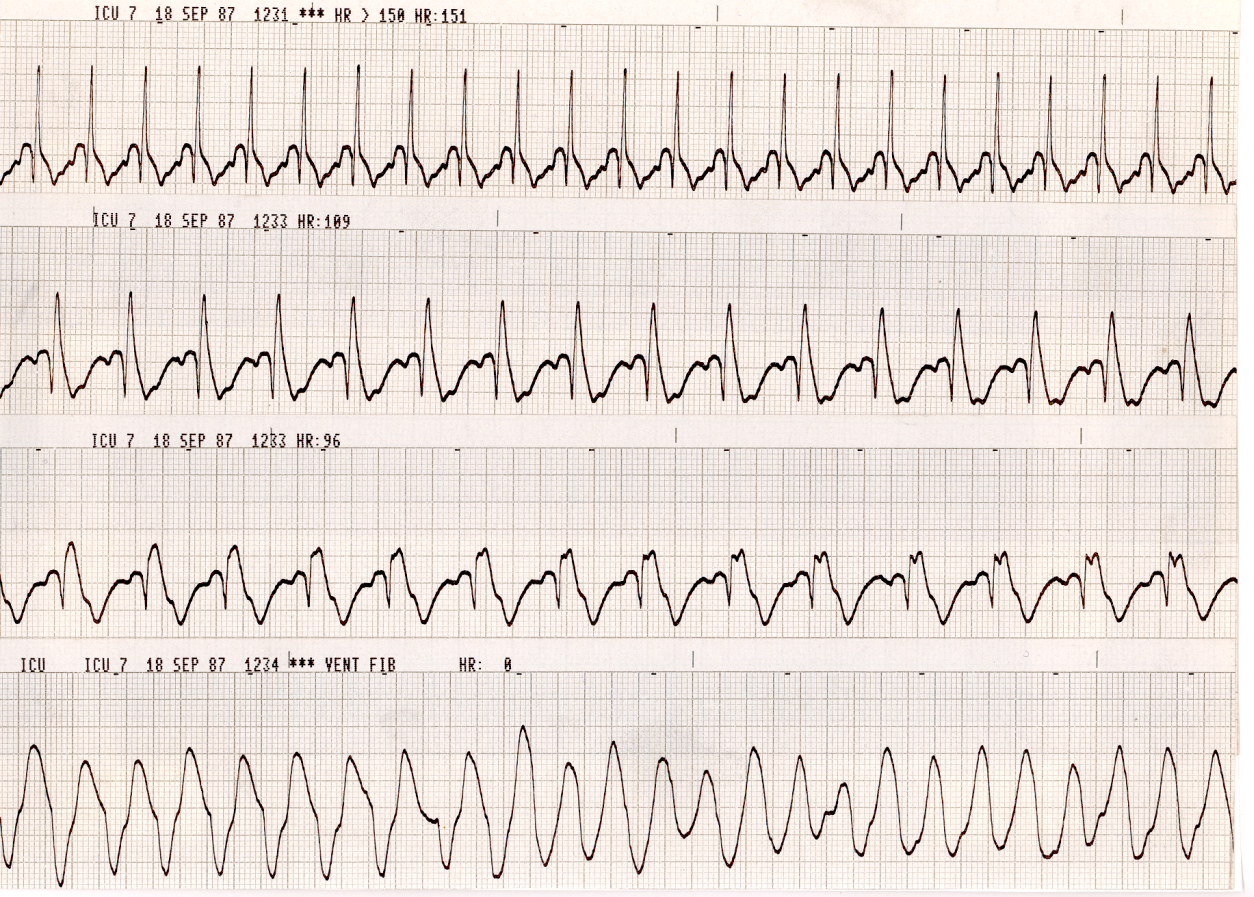 A terminally ill patient on terminal weaning, waiting for the ventilator to be turned off