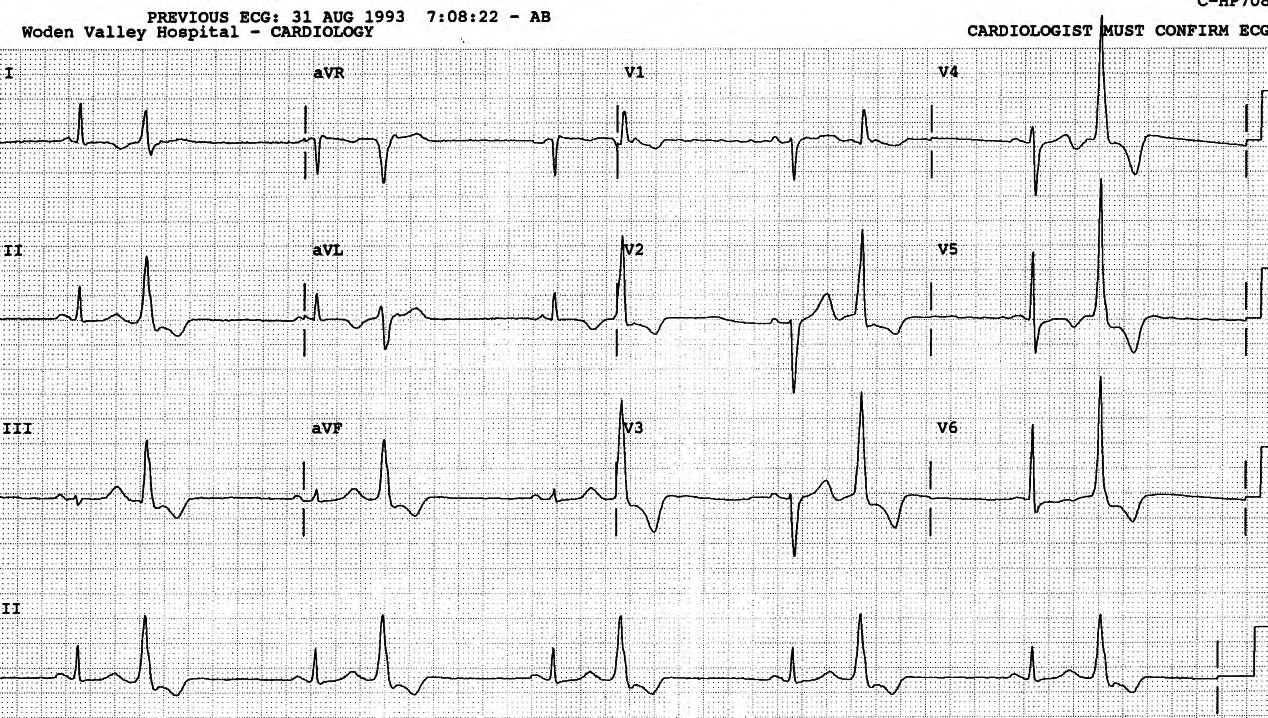 The reporting error in Fig 53 above would not have occurred if the ECG had a rhythm strip. 